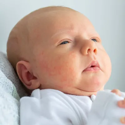 Сыпи у новорожденных | блог клиники Наше Время