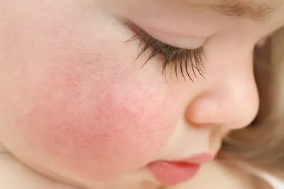 Атопический дерматит у детей!Так ли страшно ли это? | Пикабу