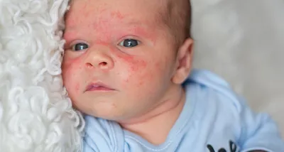 Атопический дерматит у детей: уход за кожей - Фармация и Медицина - ФМ Life