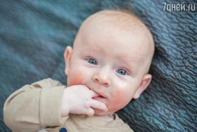 рука новорожденного с красной кожей, смазанная мазью. атопический дерматит  пищевой аллергии Стоковое Фото - изображение насчитывающей здоровье,  пеленка: 218052894