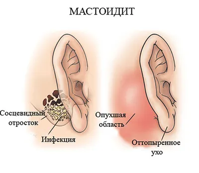 Самые популярные заболевания слуха, с которыми не служат в армии