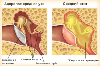 Базально-клеточный рак наружного уха, лечение в Москве