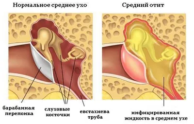 Контурная пластика мочек ушей - ЦИДК