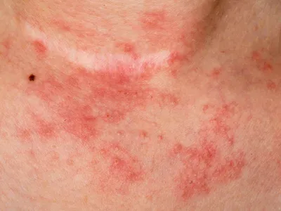 Грибковая инфекция в экземы дерматита псориазе паха. Стоковое Изображение -  изображение насчитывающей люди, чувствительно: 173009305