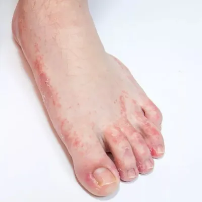 Хроническое воспаление кожи сильно отравляет жизнь
