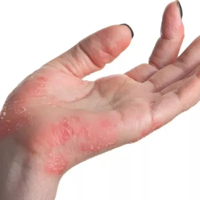 Аллергический контактный дерматит - лечение, клинические рекомендации,  причины