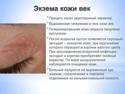 Каковы причины аллергического дерматита век? «Ochkov.net»