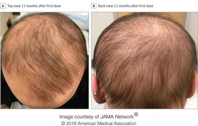 Препарат от экземы восстанавливает рост волос у пациентов с многолетней  алопецией :: Новости :: Новости трихологии