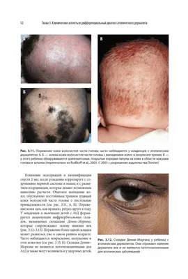 Иллюстрация 8 из 12 для Атопический дерматит и экзематозные расстройства -  Рудикофф, Коэн, Шайнфельд | Лабиринт - книги.