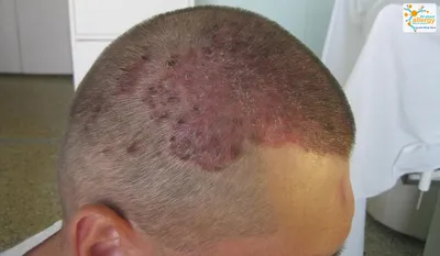 Эффективное лечение себорейного дерматита волосистой части головы