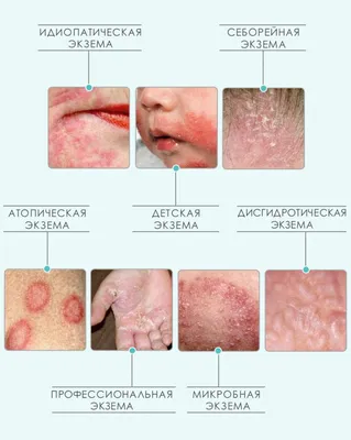 Диагноз — экзема: причины, диагностика, лечение | Здоровый подход |  Современная медицина | Дзен