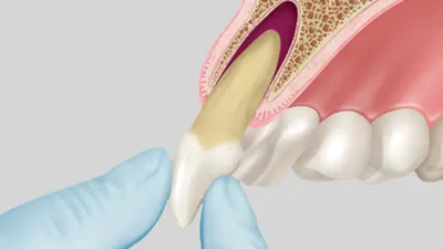 Экзостоз десны после удаления зуба 🦷 Цены на удаление экзостозов в Киеве |  CIS