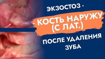 Удаление экзостоза - цены на стоматологические услуги в Москве