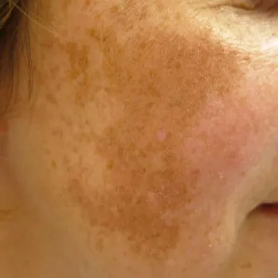 ЭЛАСТОЗ - что произошло с кожей?... - Skin Clinic E.DEM | Facebook