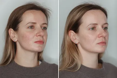 Что такое фотостарение кожи лица. | Салон красоты «Контраст»