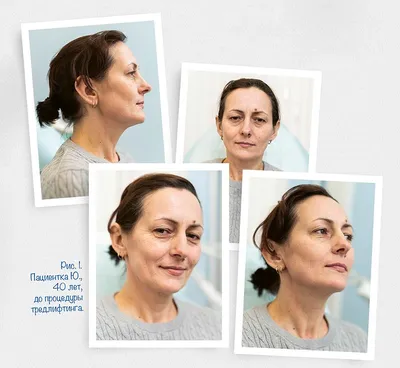 Пигментация на лице: личный опыт, фото и комментарий врача | Beauty Insider