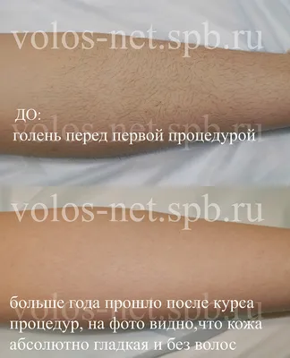 Электроэпиляция рук цены, удаление волос током - Москва