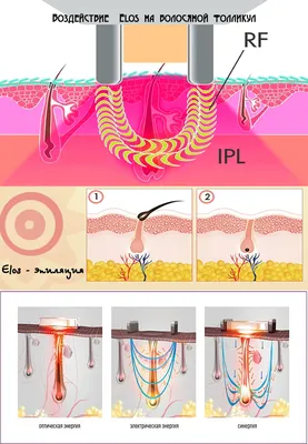ELOS эпиляция - Cтудия лазерной эпиляции и косметологии LSC