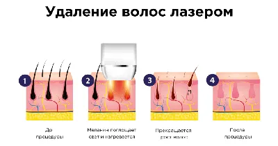 Элос Эпиляция (лазерная + фото) 2024 | ВКонтакте