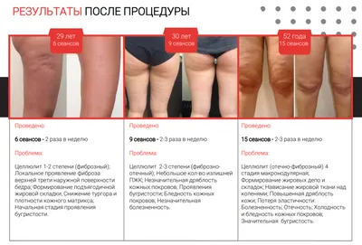 Эндосфера терапия в Симферополе — Цены на массаж эндосфера в Центре  InnoVacia — Отзывы о процедуре эндосфератерапия лица и тела