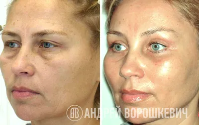 Эндоскопическая подтяжка лба | Dr. Patlazhan Clinic | Цены, фото, отзывы |  Пластическая хирургия в Киеве, Одессе, Днепре | Цены на пластические  операции, отзывы