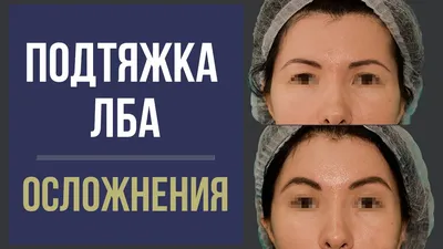 Эндоскопический лифтинг верхних 2/3 лица и блефаропластика у Хрусталевой  И.Э.