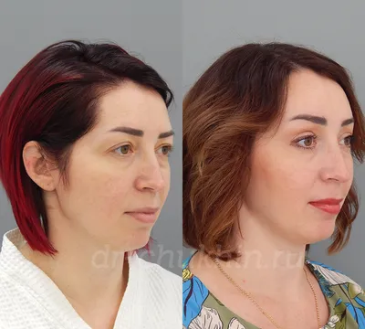 Подтяжка бровей / Brow lift в Москве в Damas Medical Center