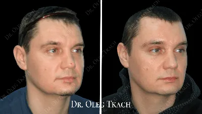 Подтяжка бровей / Brow lift в Москве в Damas Medical Center