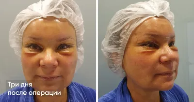 Эндоскопическая подтяжка лба | Dr. Patlazhan Clinic | Цены, фото, отзывы |  Пластическая хирургия в Киеве, Одессе, Днепре | Цены на пластические  операции, отзывы