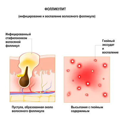 Стафилококки — Википедия