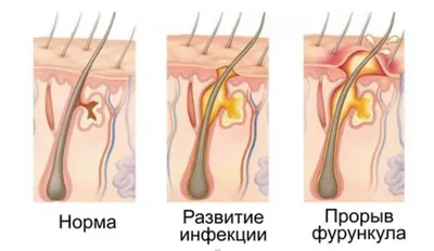 Что такое эпидермальный барьер