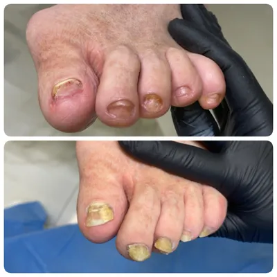 Лечение грибка ногтей на ногах (онихомикоза) лазером – цены на услугу в  Химках, Эстетика Групп (Москва и МО)