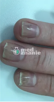 Эпидермофития. Онихорексис.... - Victoria Metreveli Nail Art | Facebook