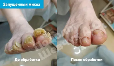 Лечение и профилактика утолщенных ногтей в Киеве