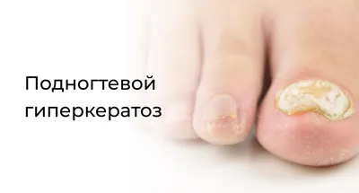 ✔️ Протезирование ногтевой пластины на ногах и руках - podonails.com