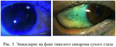 Рис. 3. Эписклерит на фоне тяжелого синдрома сухого глаза