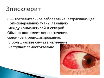 Склерит и эписклерит: как проявляются, что делать? | МедикСити | Дзен