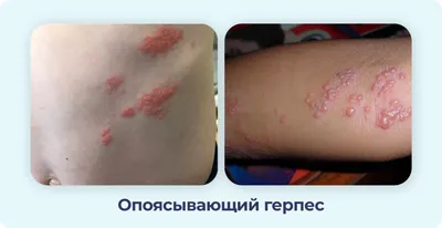 Атопический дерматит: правила ухода за кожей