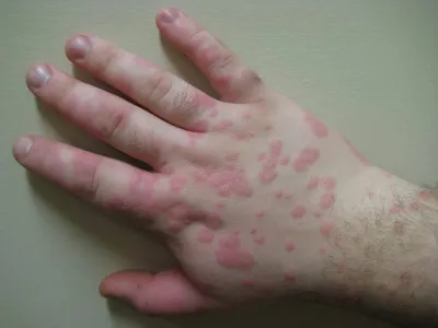 Инфекционная эритема (Erythema infectiosum)