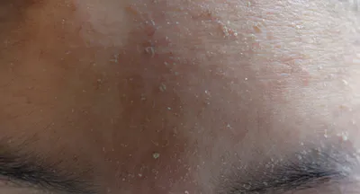 Периоральный дерматит, как спасти кожу? Проверено на себе 👍 - YouTube