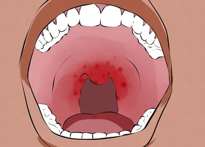 Лечение эритроплакии полости рта