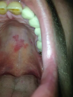 Болезни слизистой оболочки полости рта и губ - DENTALMAGAZINE.RU