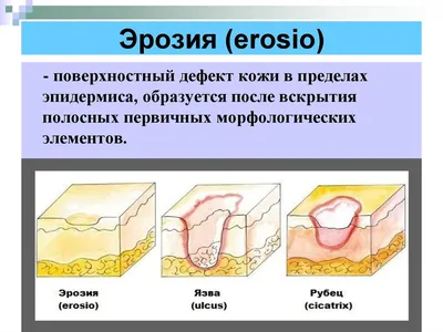 Рак кожи: симптомы, фото, диагностика и лечение