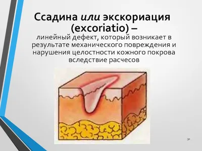 Обработка эрозий и язв кожи по схеме местного лечения в Екатеринбурге