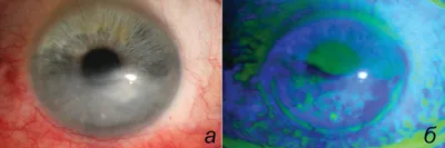 Центр Микрохирургии Глаза on Instagram: \"👁 Эрозия роговицы — это  повреждение верхнего слоя (эпителия) роговицы, из-за которого он отделяется  от нижележащего слоя, в результате чего образуется ссадина. Эрозия роговицы  - травма поверхностная,