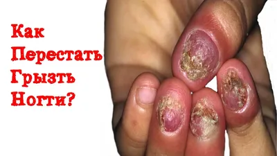 Как перестать грызть ногти - ученые нашли решение | РБК Украина
