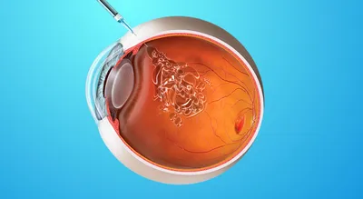 Биоревитализация кожи вокруг глаз: фото до и после, препараты - клиника  Абсолют Мед