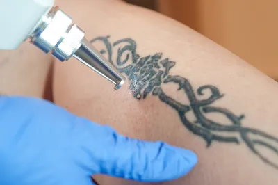 Способы удаления татуировок: 6 проверенных методов | блог Permanent Profy -  Permanent Profy