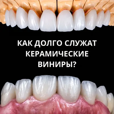 Фарфоровые виниры в Киеве – цена установки виниров из фарфора в ID Dent