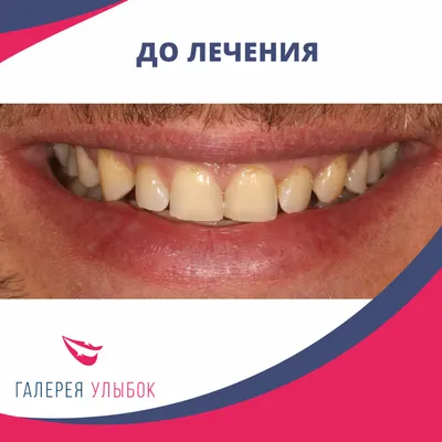 ФАРФОРОВЫЕ ВИНИРЫ Цены и отзывы в Измире, Турция - Hollywood Dental